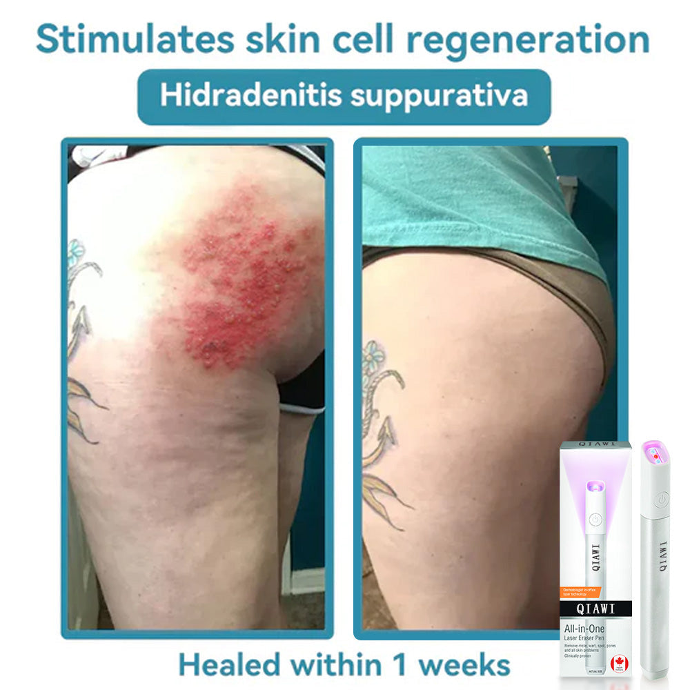 ✨✨✨✨✨QIAWI™ All-in-One CO₂ Laser Eraser Pen | Removes Moles, Warts, Skin Flaws & Pigmentation